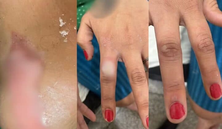 Homem é preso suspeito de atear fogo à mulher após se irritar por ela ter pintado as unhas de vermelho