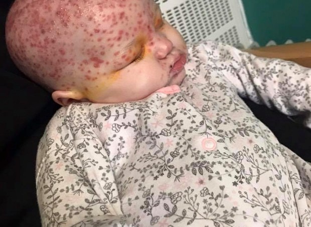 Mae Compartilha Foto De Filha Com Herpes Para Conscientizar Sobre Visitas A Bebes 98fm Curitiba Sintonize 98 9